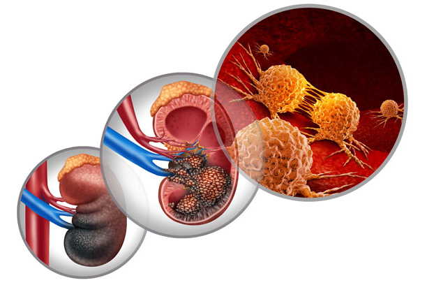 Evolving Systemic Treatment Landscape for Patients With Advanced Renal Cell Carcinoma