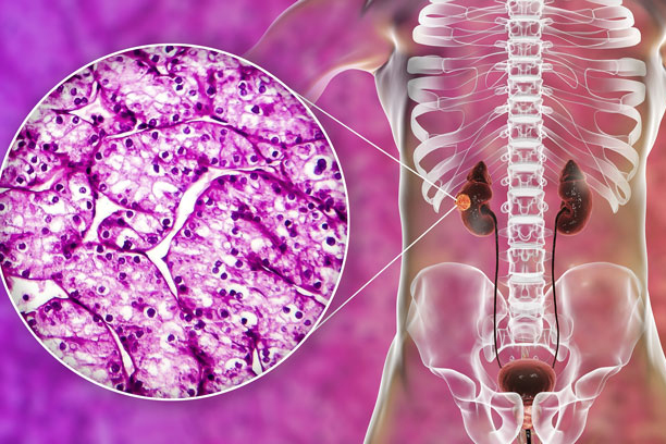 Current Treatment Landscape of Advanced Papillary Renal Cancer