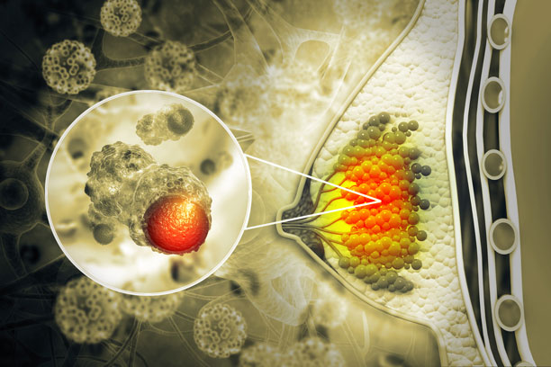 CDK 4/6 Inhibitors: Evolution and Revolution in the Management of ER+ Metastatic Breast Cancer