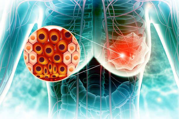 Cyclin E1 Expression and Palbociclib Efficacy in Previously Treated Hormone Receptor–Positive Metastatic Breast Cancer